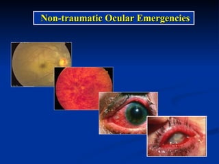 Non-traumatic Ocular Emergencies 