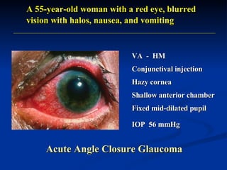 VA  -  HM Conjunctival injection Hazy cornea Shallow anterior chamber Fixed mid-dilated pupil  A 55-year-old woman with a red eye, blurred vision with halos, nausea, and vomiting Acute Angle Closure Glaucoma IOP  56 mmHg 