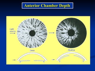Anterior Chamber Depth 