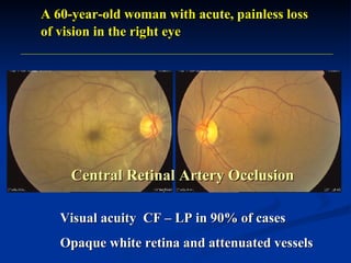 A 60-year-old woman with acute, painless loss of vision in the right eye Visual acuity  CF – LP   in 90% of cases Opaque white retina and attenuated vessels Central Retinal Artery Occlusion 