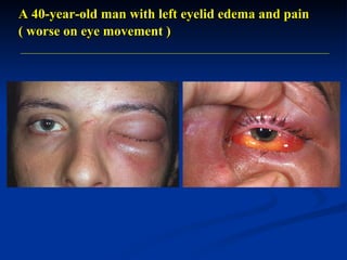 A 40-year-old man with left eyelid edema and pain   ( worse on eye movement ) 