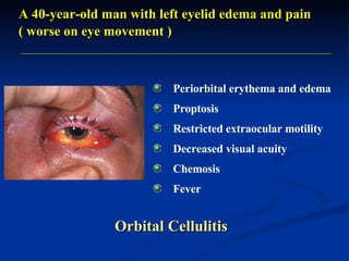 A 40-year-old man with left eyelid edema and pain   ( worse on eye movement ) Periorbital erythema and edema Proptosis Restricted extraocular motility Decreased visual acuity Chemosis Fever Orbital Cellulitis 