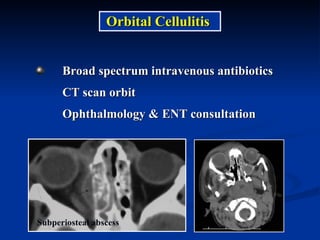Broad spectrum intravenous antibiotics CT scan orbit Ophthalmology & ENT consultation  Orbital Cellulitis Subperiosteal abscess 