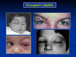 Preseptal Cellulitis 