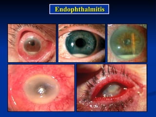 Endophthalmitis 
