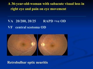A 36-year-old-woman with subacute visual loss in  right eye and pain on eye movement  VA  20/200, 20/25  RAPD +ve OD VF  central scotoma OD Retrobulbar optic neuritis 