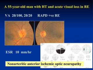 A 55-year-old man with HT and acute visual loss in RE  VA  20/100, 20/20  RAPD +ve RE  Nonarteritic anterior ischemic optic neuropathy ESR  10  mm/hr  