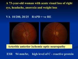 A 73-year-old woman with acute visual loss of right eye, headache, anorexia and weight loss VA  10/200, 20/25  RAPD + ve RE ESR  94 mm/hr,  high level of C - reactive protein Arteritic anterior ischemic optic neuropathy 