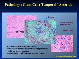 Pathology : Giant Cell ( Temporal ) Arteritis 
