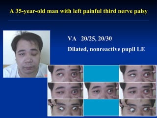 A 35-year-old man with left painful third nerve palsy  VA  20/25, 20/30  Dilated, nonreactive pupil LE 