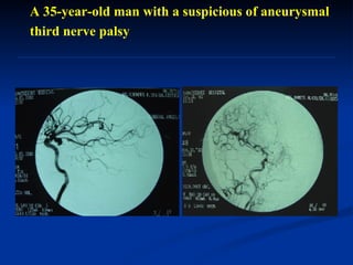 A 35-year-old man with a suspicious of aneurysmal third nerve palsy  