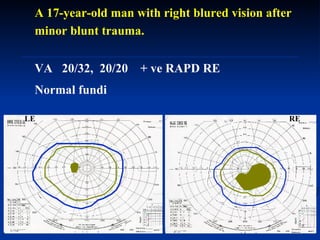 A 17-year-old man with right blured vision after  minor blunt trauma.  VA  20/32,  20/20  + ve RAPD RE Normal fundi  RE LE 