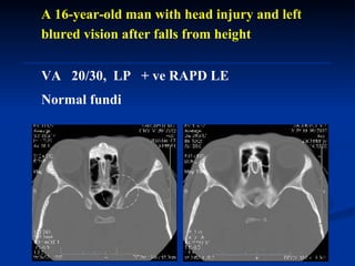 A 16-year-old man with head injury and left blured vision after falls from height  VA  20/30,  LP  + ve RAPD LE  Normal fundi 