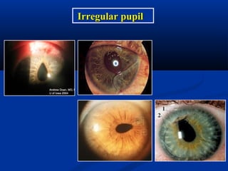 Irregular pupilIrregular pupil
 