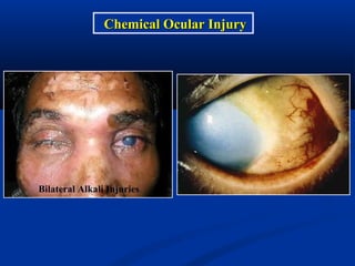Bilateral Alkali Injuries
Chemical Ocular InjuryChemical Ocular Injury
 