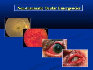 Non-traumatic Ocular EmergenciesNon-traumatic Ocular Emergencies
 