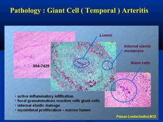 Pathology : Giant Cell ( Temporal ) Arteritis
 
