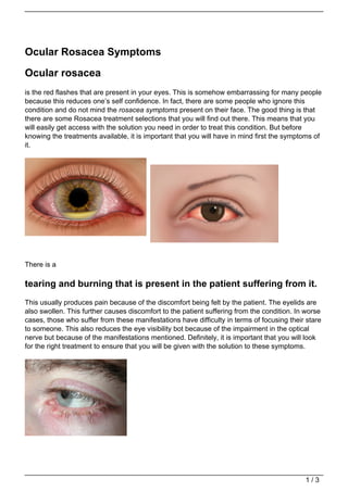 Ocular Rosacea Symptoms

Ocular rosacea
is the red flashes that are present in your eyes. This is somehow embarrassing for many people
because this reduces one’s self confidence. In fact, there are some people who ignore this
condition and do not mind the rosacea symptoms present on their face. The good thing is that
there are some Rosacea treatment selections that you will find out there. This means that you
will easily get access with the solution you need in order to treat this condition. But before
knowing the treatments available, it is important that you will have in mind first the symptoms of
it.




There is a

tearing and burning that is present in the patient suffering from it.
This usually produces pain because of the discomfort being felt by the patient. The eyelids are
also swollen. This further causes discomfort to the patient suffering from the condition. In worse
cases, those who suffer from these manifestations have difficulty in terms of focusing their stare
to someone. This also reduces the eye visibility bot because of the impairment in the optical
nerve but because of the manifestations mentioned. Definitely, it is important that you will look
for the right treatment to ensure that you will be given with the solution to these symptoms.




                                                                                            1/3
 