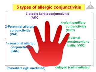 1- seasonal allergic
conjunctivitis
(SAC)
2-Perennial allergic
conjunctivitis
(PAC
3-atopic keratoconjunctivitis
(AKC)
4-giant papillary
conjunctivitis
(GPC)
5-vernal
keratoconjunc
tivitis (VKC)
5 types of allergic conjunctivitis
immediate (IgE mediated) delayed (cell mediated
 