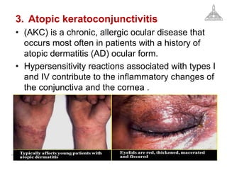 3. Atopic keratoconjunctivitis
• (AKC) is a chronic, allergic ocular disease that
occurs most often in patients with a history of
atopic dermatitis (AD) ocular form.
• Hypersensitivity reactions associated with types I
and IV contribute to the inflammatory changes of
the conjunctiva and the cornea .
 