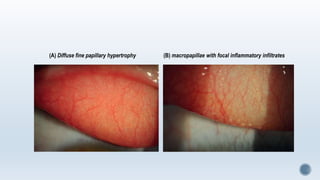 (A) Diffuse fine papillary hypertrophy (B) macropapillae with focal inflammatory infiltrates
 