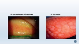 (C) macropapillae with diffuse infiltrate (D) giant papillae
 