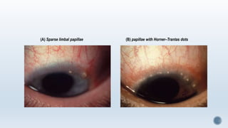 (A) Sparse limbal papillae (B) papillae with Horner–Trantas dots
 