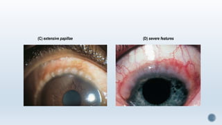 (C) extensive papillae (D) severe features
 