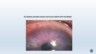 (A) Superior punctate erosions and mucus stained with rose Bengal
 
