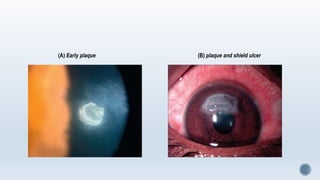 (A) Early plaque (B) plaque and shield ulcer
 