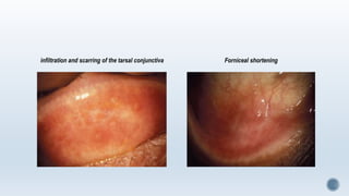 infiltration and scarring of the tarsal conjunctiva Forniceal shortening
 