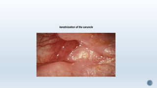 keratinization of the caruncle
 