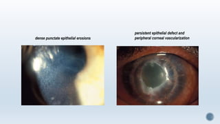 dense punctate epithelial erosions
persistent epithelial defect and
peripheral corneal vascularization
 