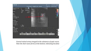 Central retinal artery imaged in the substance of optic nerve.
Note the short wave forms at the bottom, indicating low flow
 