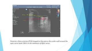 Posterior ciliary arteries (PCA) imaged as they pierce the ocular wall around the
optic nerve head. CRA is in the substance of Optic nerve.
 