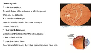 OCULAR BLUNT TRAUMA-1 .pptx