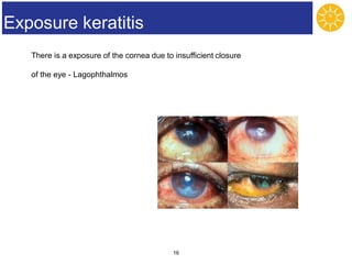 Ocular diseases.ppt