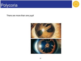 Polykorie Ocular diseases.ppt
