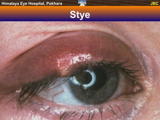 June 28, 2014 Disorder of Lids and Red Eye 5
JBCHimalaya Eye Hospital, Pokhara JBC
Stye
 