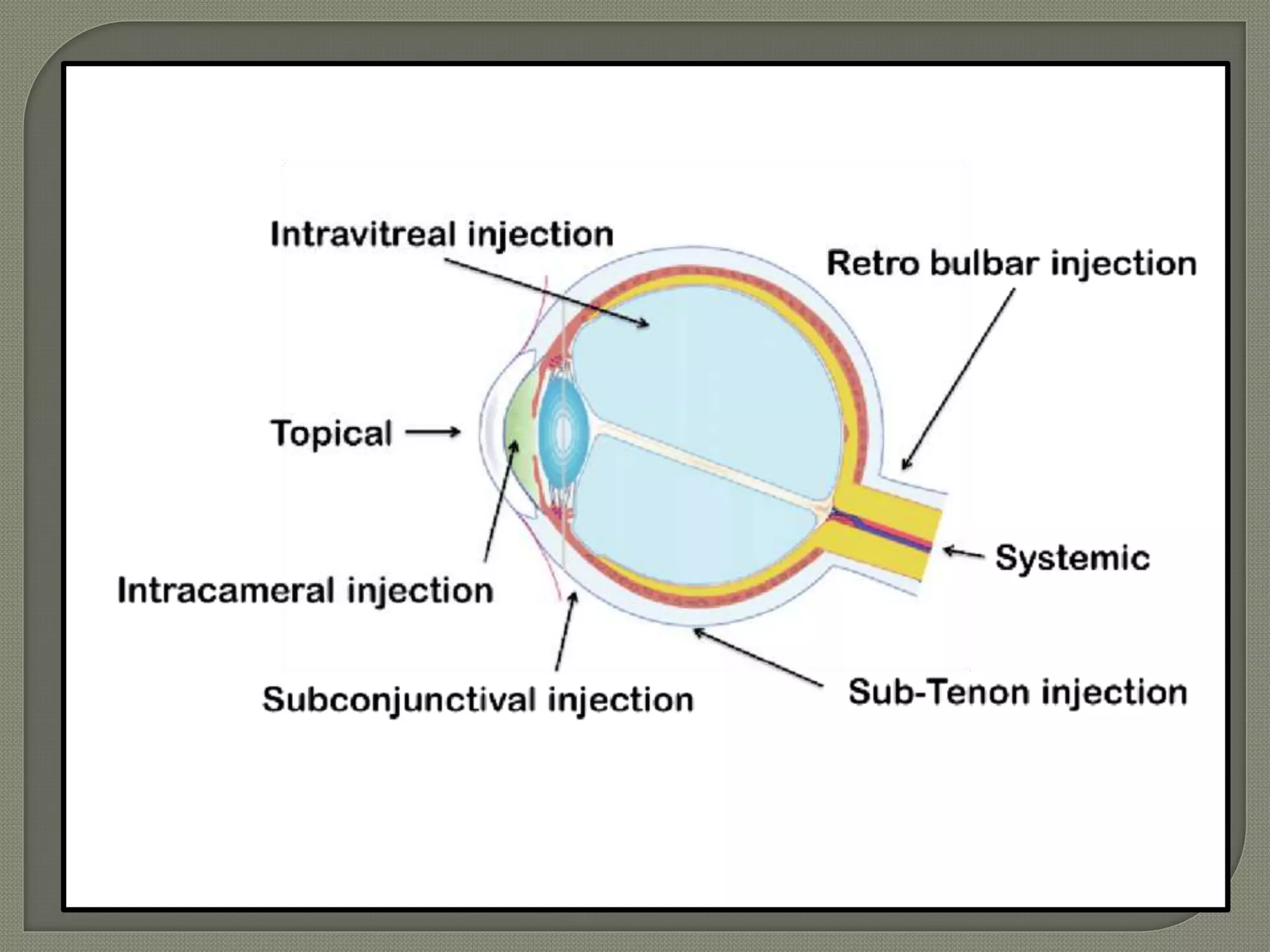 Ocular Injection Pattern OCULAR DRUG DELIVERY SYSTEM.pptx