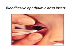 Bioadhesive ophthalmic drug insert
 