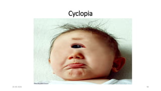 Cyclopia Child Ocular embryology | PPTX