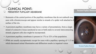 Ppm In Eye OCULAR EMBRYOLOGY development of the eye.pptx