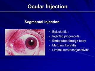 Ocular Injection
• Episcleritis
• Injected pinguecula
• Embedded foreign body
• Marginal keratitis
• Limbal keratoconjunctivitis
Segmental injection
 