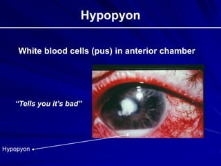 Hypopyon
White blood cells (pus) in anterior chamber
“Tells you it’s bad”
Hypopyon
 