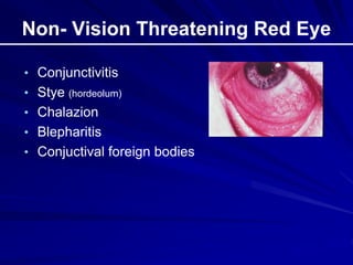 Non- Vision Threatening Red Eye
• Conjunctivitis
• Stye (hordeolum)
• Chalazion
• Blepharitis
• Conjuctival foreign bodies
 