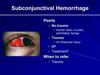 Subconjunctival Hemorrhage
Pearls
• No trauma
• normal vision, no pain,
self-limited, benign
• Trauma
• r/o intraocular injury
• BP
• Treatment?
When to refer
• Trauma
 