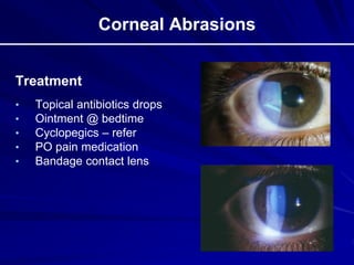 Corneal Abrasions
Treatment
• Topical antibiotics drops
• Ointment @ bedtime
• Cyclopegics – refer
• PO pain medication
• Bandage contact lens
 