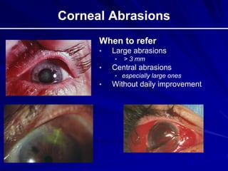 Corneal Abrasions
When to refer
• Large abrasions
• > 3 mm
• Central abrasions
• especially large ones
• Without daily improvement
 