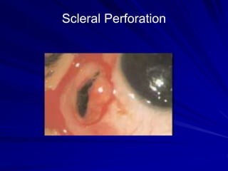 Scleral Perforation
 